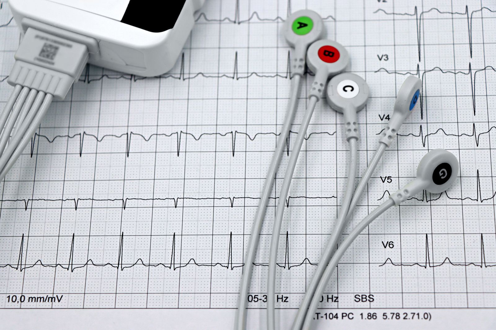 Detailed ECG Leads on Heart Monitor Printout